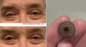 a prosthetic lens with a natural look to cover their scarred eye