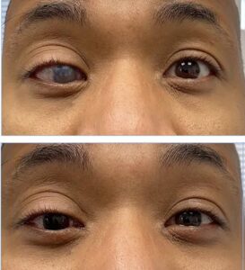 soft prosthetic scleral lens