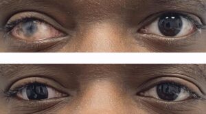 a prosthetic scleral lens
