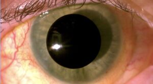 an occlusion pupil custom prosthetic contact lens