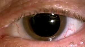 an occlusion pupil custom prosthetic contact lens