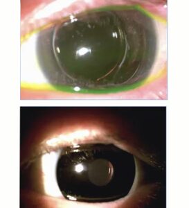 patient presented with light sensitivity after an accidental trauma