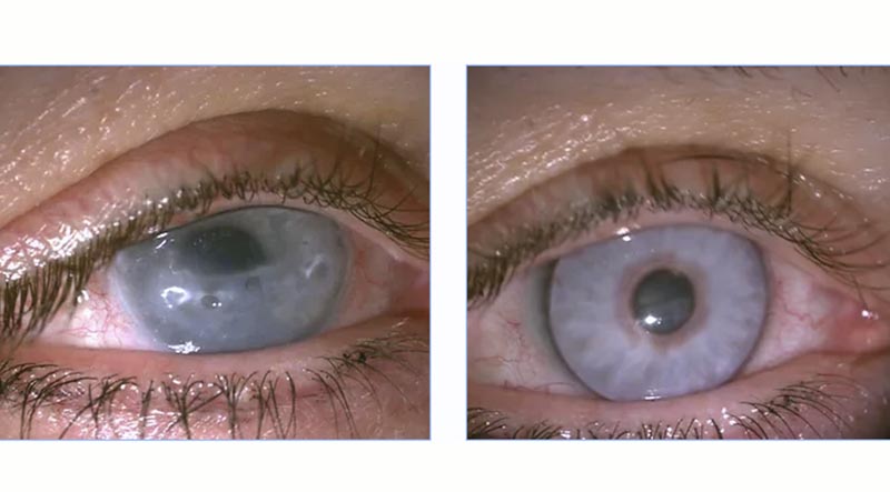 scarred right eye. They were wearing a prosthetic contact lens