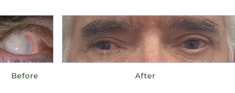 scarred right eye. They were wearing a prosthetic contact lens